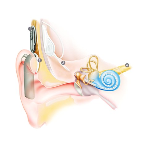 Cochlear Implant 1. The Sound Processor captures sounds and converts them into digital signals. 2. The Processor sends digital signals to Internal Implant. 3. The implant turns the signals to electrical impulses and sends them to an array inside the Cochlea. 4. The Electrodes stimulate hearing nerve, and the signal is sent to the brain.